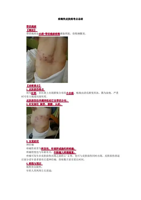 病毒性皮肤病考点总结