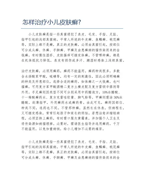 怎样治疗小儿皮肤癣 