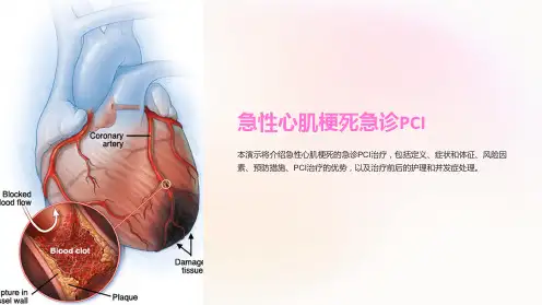 急性心肌梗死急诊PCI