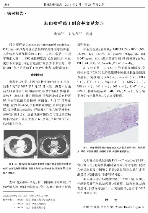 肺肉瘤样癌1例合并文献复习