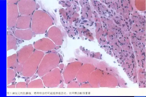 肌萎缩侧索硬化症(ALS)