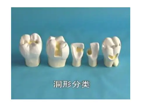 口腔窝洞的洞形图片