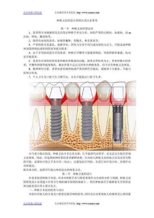 种植义齿的设计原则以及注意事项