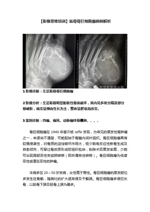 【影像思维培训】跖骨骨巨细胞瘤病例解析