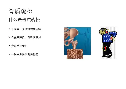 健康宣教_骨质疏松