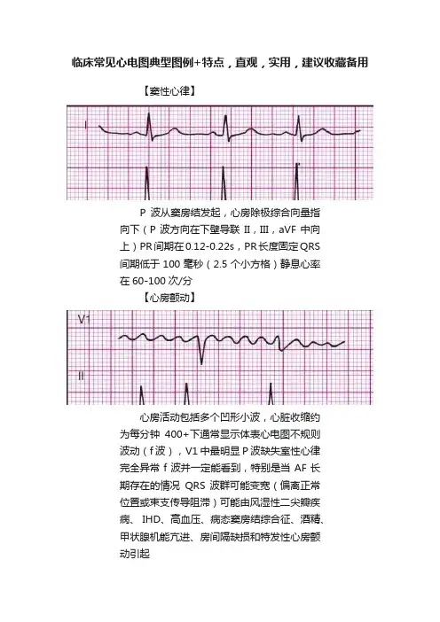 临床常见心电图典型图例+特点，直观，实用，建议收藏备用