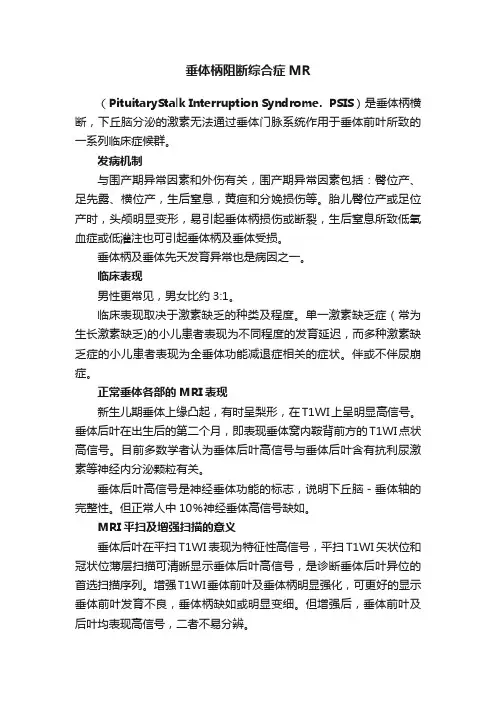 垂体柄阻断综合症MR