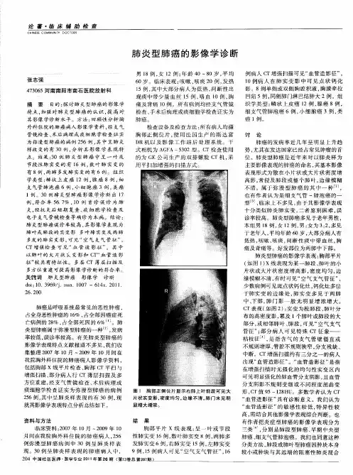 肺炎型肺癌的影像学诊断