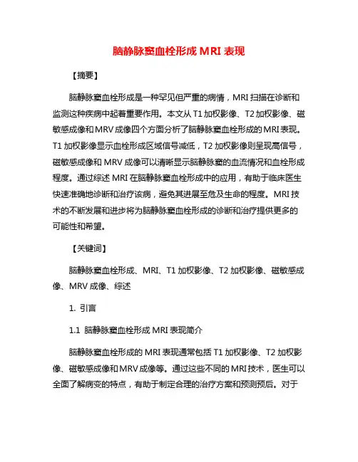 脑静脉窦血栓形成MRI表现