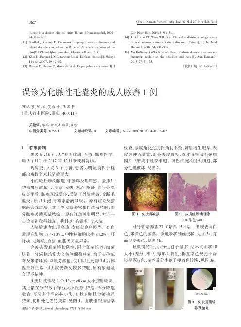 误诊为化脓性毛囊炎的成人脓癣1例