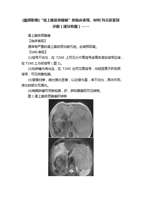 [腹部影像]“肾上腺皮质腺癌”的临床表现、MRI特点及鉴别诊断（建议收藏）~~~