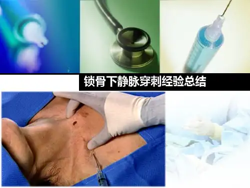 锁骨下静脉穿刺经验总结