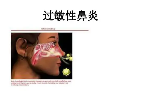 过敏性鼻炎PPT课件