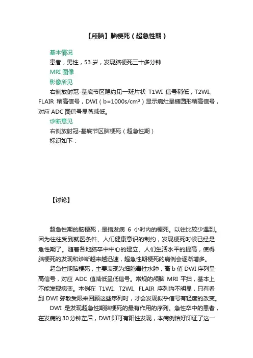 【颅脑】脑梗死（超急性期）