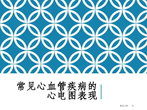 常见心血管疾病的心电图表现PPT课件