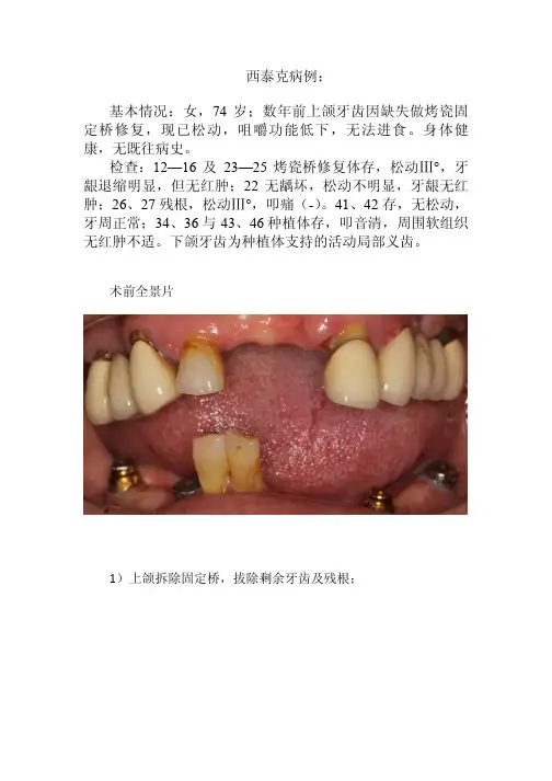 CTech半口种植即刻修复病例（精品）