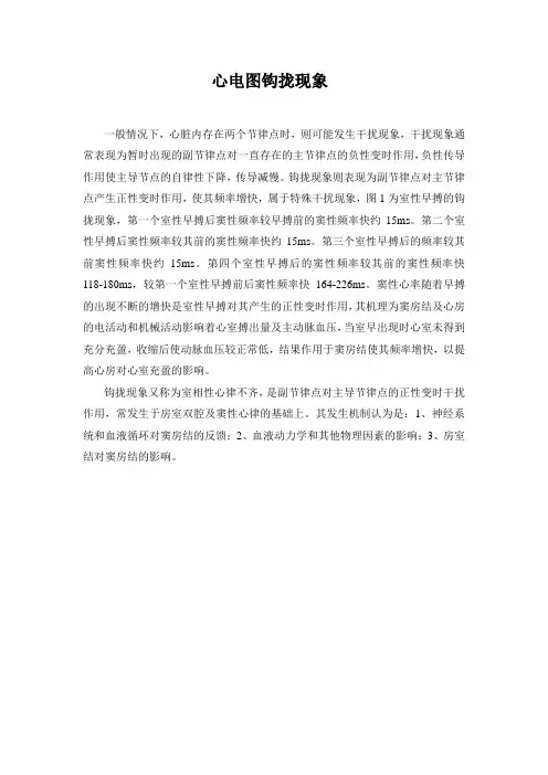 心电图钩拢现象