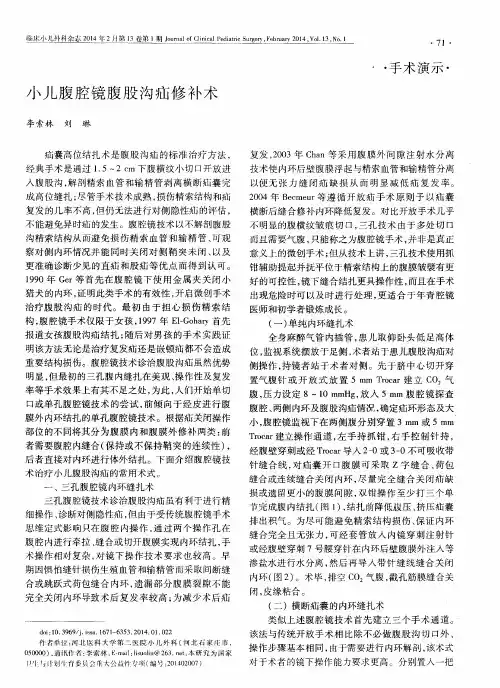 小儿腹腔镜腹股沟疝修补术