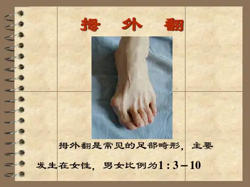 拇外翻手术介绍