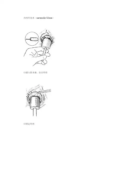 内痔环切术