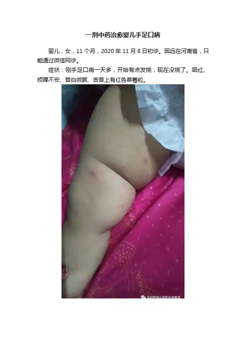 一剂中药治愈婴儿手足口病