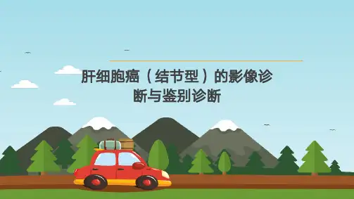 肝细胞癌(结节型)的影像诊断与鉴别诊断