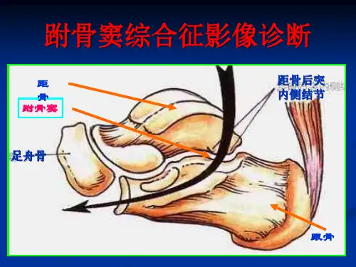 跗骨窦综合征影像诊断 PPT课件