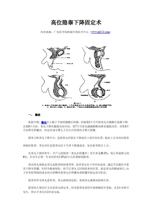 高位隐睾下降固定术