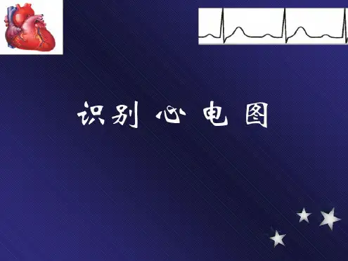 实用心电图(常见异常心电图)-h知识讲解-2022年学习资料