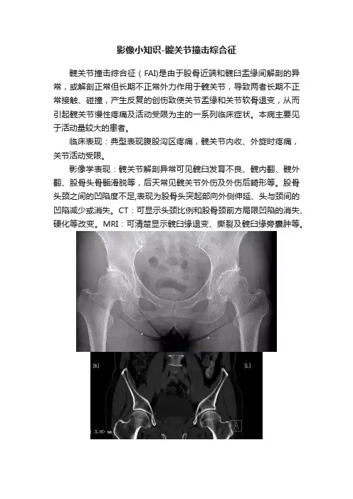 影像小知识-髋关节撞击综合征