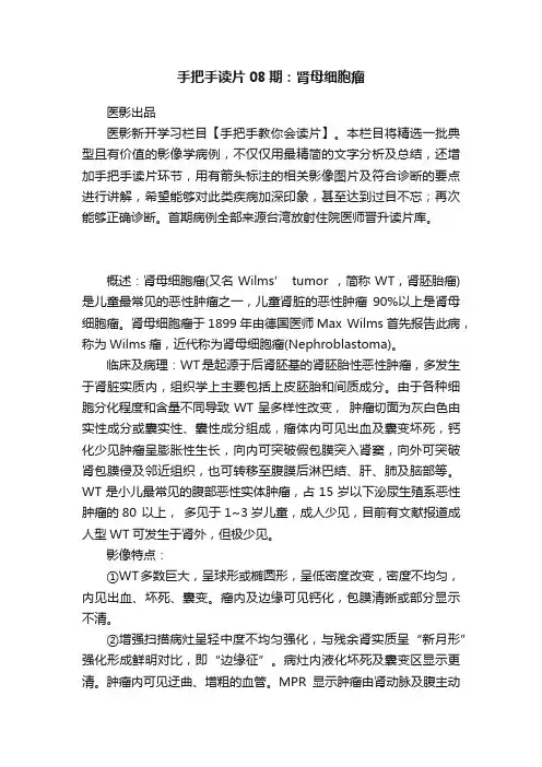 手把手读片08期：肾母细胞瘤