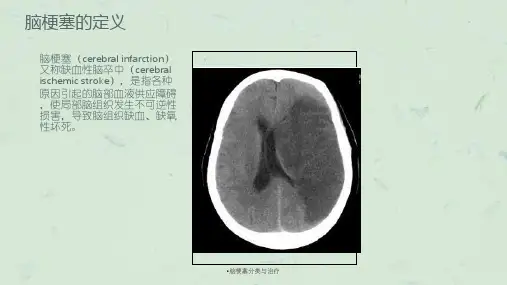 脑梗塞分类与治疗课件