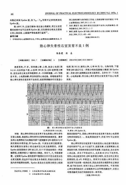 致心律失常性右室发育不良1例