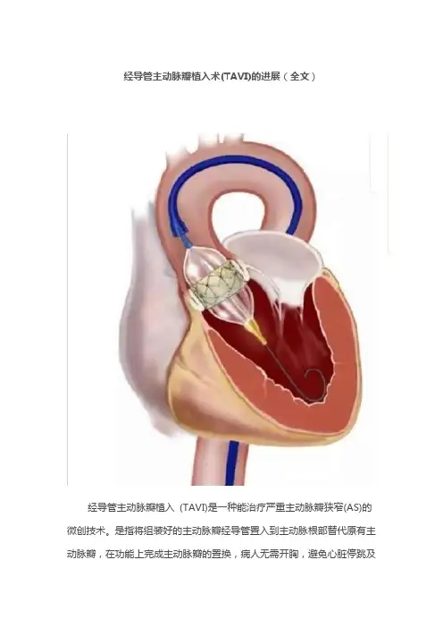 经导管主动脉瓣植入术(TAVI)的进展(全文)