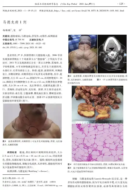 马德龙病1例