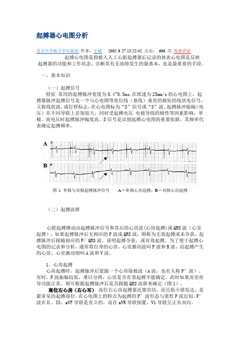起搏器心电图分析