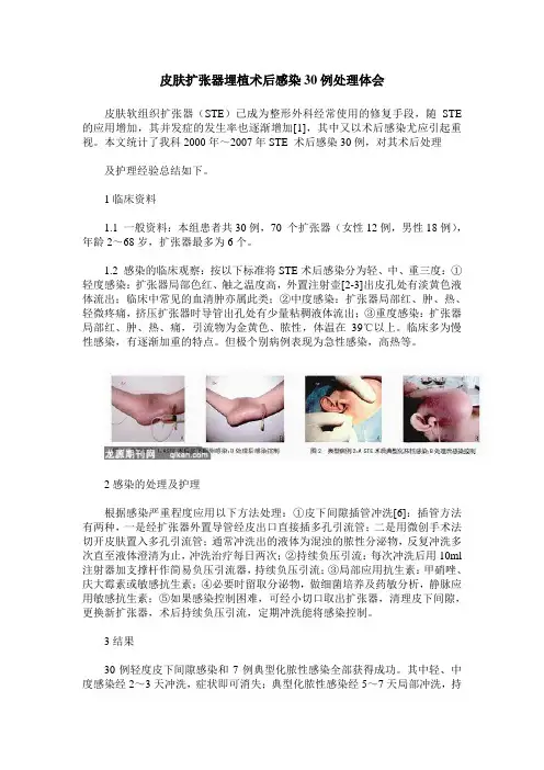 皮肤扩张器埋植术后感染30例处理体会
