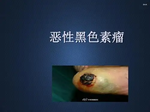 恶性黑色素瘤  ppt课件