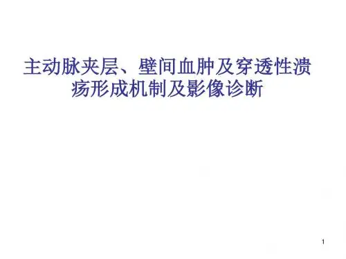 主动脉壁间血肿ppt课件