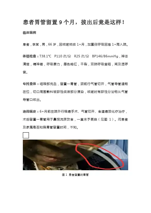 患者胃管留置9个月,拔出后竟是这样!