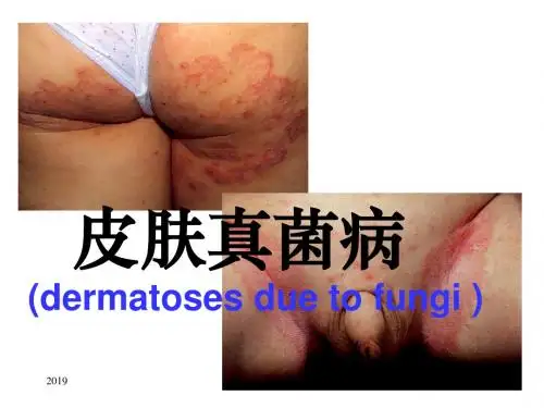 真菌性皮肤病ppt课件