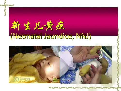 新生儿黄疸的护理PPT课件