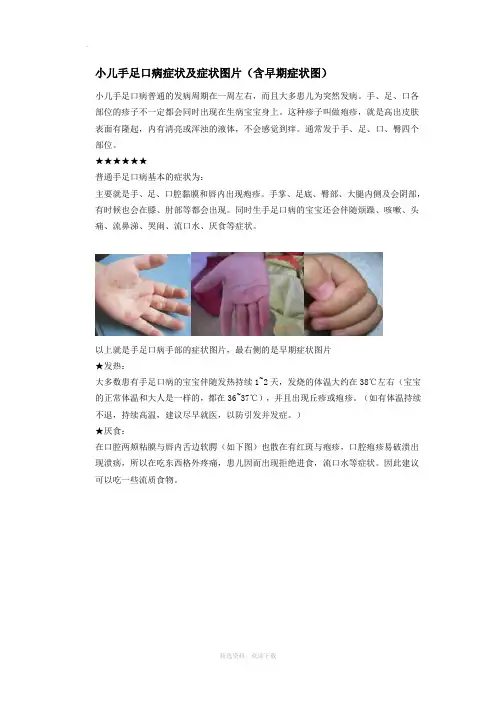 小儿手足口病症状及症状图片