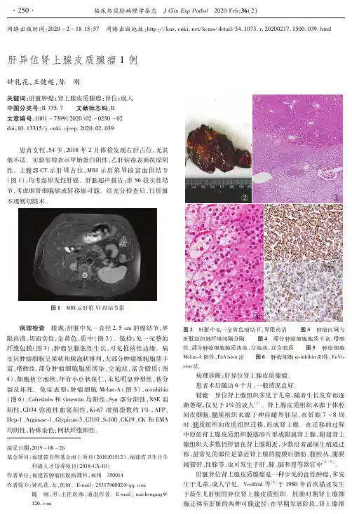 肝异位肾上腺皮质腺瘤1例
