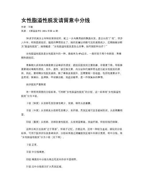 女性脂溢性脱发请留意中分线