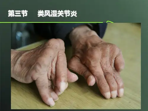 类风湿关节炎
