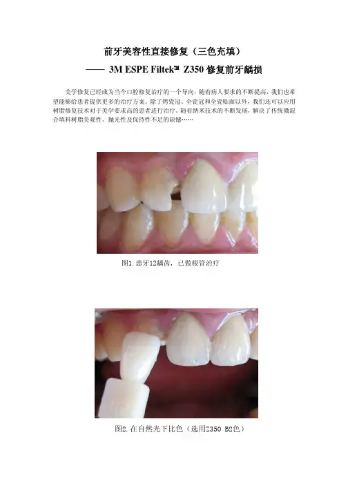 前牙美容性直接修复(三色充填)——3MESPEFiltek