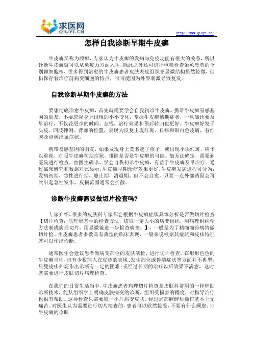 怎样自我诊断早期牛皮癣