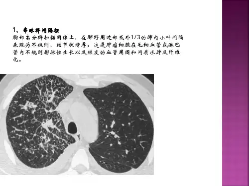 胸部常见CT征象表现整理篇