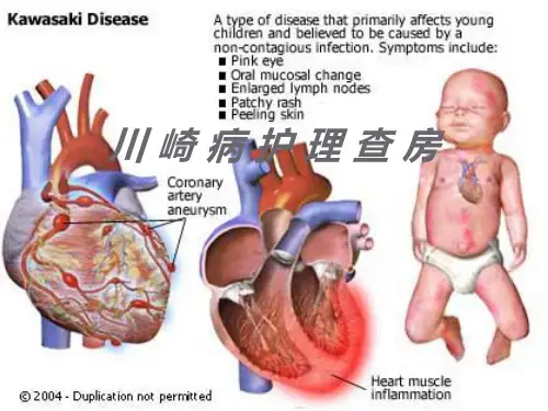 川崎病的护理查房ppt课件
